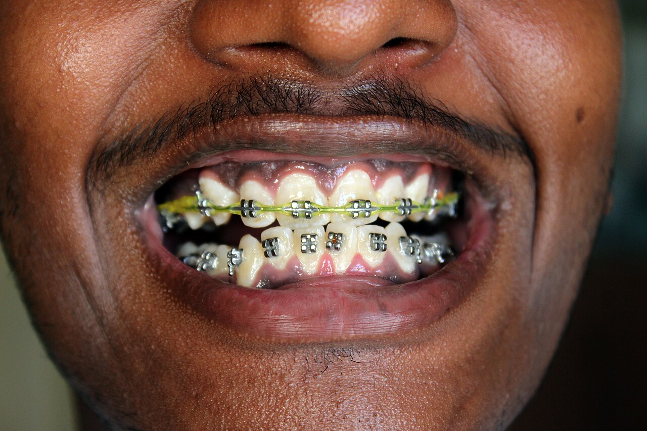Close-up of teeth with metal braces