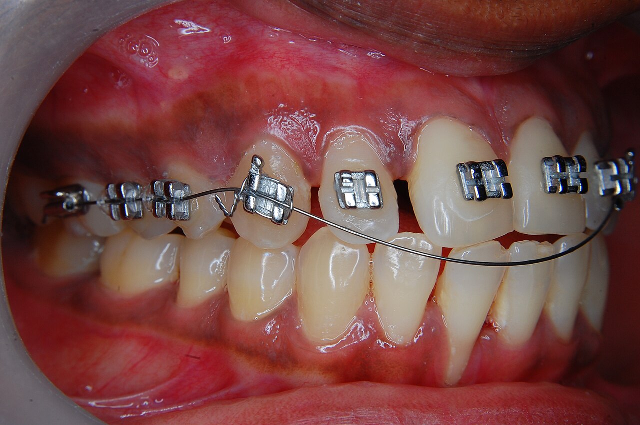 Orthodontic braces detail