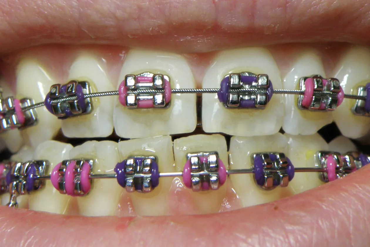 Braces with pink and purple elastic ties, close-up