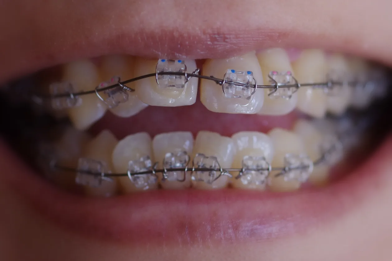 Clear ceramic braces on teeth, close-up